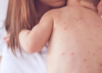 Rritje alarmante e rasteve në të gjithë vendin, shpallet epidemia e fruthit