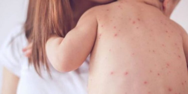 Rritje alarmante e rasteve në të gjithë vendin, shpallet epidemia e fruthit