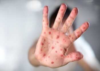 Rikthimi i fruthit në vend/ “Komplikacionet janë të rënda”, mjeku pediatër apel: Vaksinimi, e vetmja mënyrë për mbrojtjen e fëmijëve