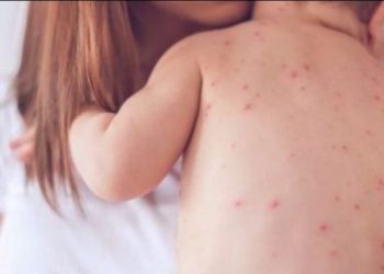 Fruthi, apel për vaksinim, në 3 muaj preken 12 fëmijë