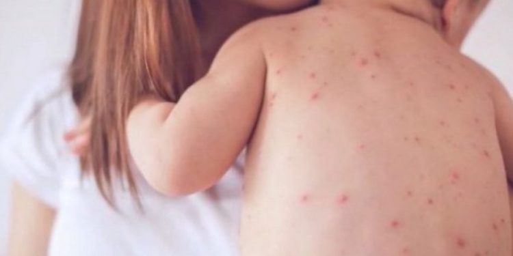 Fruthi, apel për vaksinim, në 3 muaj preken 12 fëmijë