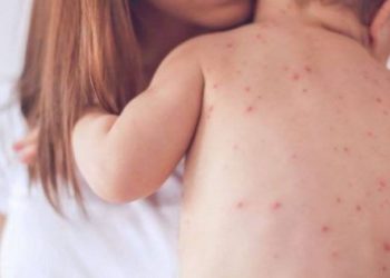 Mosvaksinimi solli shpërthim të fruthit, mjekët: 8% e fëmijëve nuk kanë marrë dozën e dytë