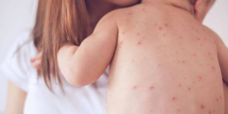 Mosvaksinimi solli shpërthim të fruthit, mjekët: 8% e fëmijëve nuk kanë marrë dozën e dytë