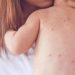 Mosvaksinimi solli shpërthim të fruthit, mjekët: 8% e fëmijëve nuk kanë marrë dozën e dytë