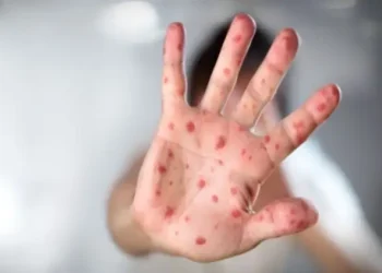 Rritja e rasteve me fruth: Ekspertja apelon për vaksinimin e fëmijëve