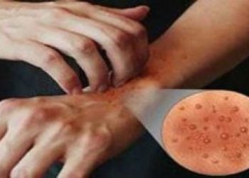 Italia në alarm, zgjebja po përhapet me shpejtësi
