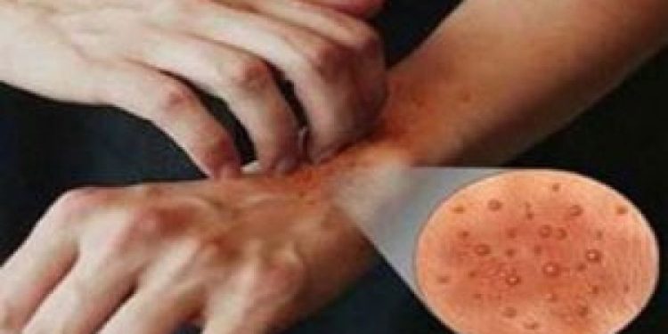 Italia në alarm, zgjebja po përhapet me shpejtësi