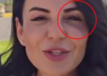 Ç’po ndodh me ministren Balluku? Pas ‘goditjes’ nga SPAK, shfaqet me sy të nxirë