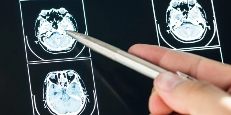 Një në tre shqiptarë vuan nga sëmundjet e sistemit nervor