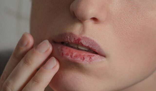 Çfarë të bëni kur ju plasariten buzët gjatë dimrit