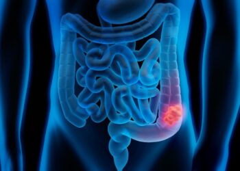 Gastroenterologu Avni Haziri: Kanceri i zorrës së trashë mund të zhvillohet pa asnjë simptomë