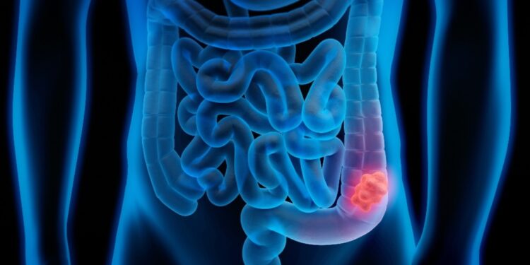 Gastroenterologu Avni Haziri: Kanceri i zorrës së trashë mund të zhvillohet pa asnjë simptomë