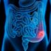 Gastroenterologu Avni Haziri: Kanceri i zorrës së trashë mund të zhvillohet pa asnjë simptomë