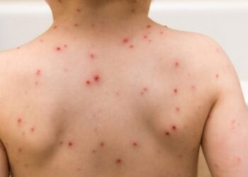 Infektimet me fruth/ Ministria e Shëndetësisë e mohon, por OBSH heq Shqipërinë nga lista e vendeve pa këtë sëmundje