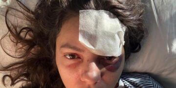 U plagos gjatë protestave me granatën e gazit, rrëfen aktivistja: Ta harrojnë se dhuna na thyen