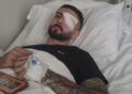 Erjon Vishkulli rrëfen momentin kur u qëllua me plumb gome në sy